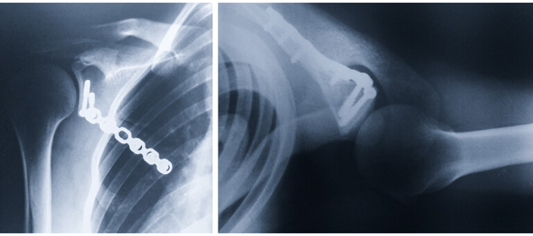 tomografia de fratura da escápula e o pós operatório